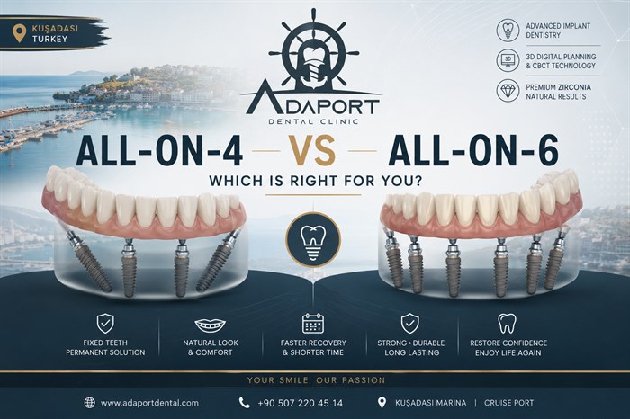 All-on-4 vs All-on-6: Which Full Mouth Implant Solution Is Right for You?