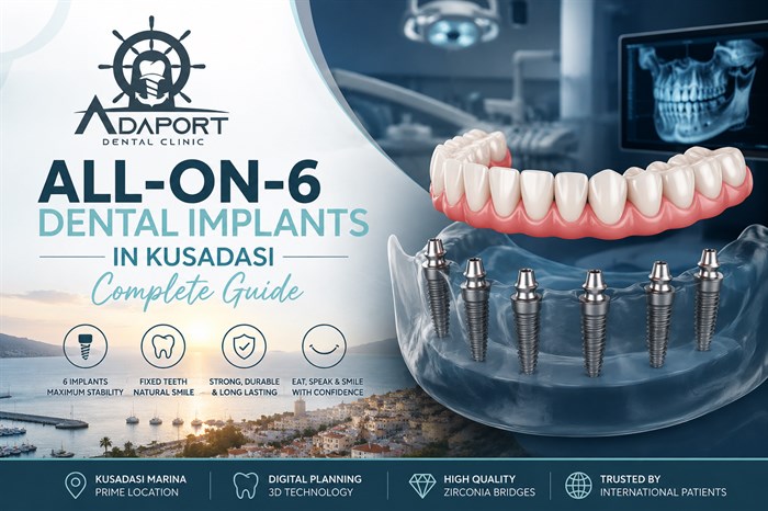All-on-6 Dental Implants in Kusadasi (2026 Complete Guide)