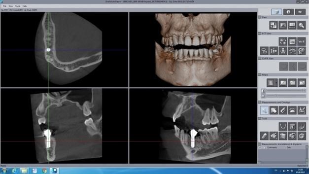 İmplant Öncesi 3D Tomografi Neden Gereklidir?