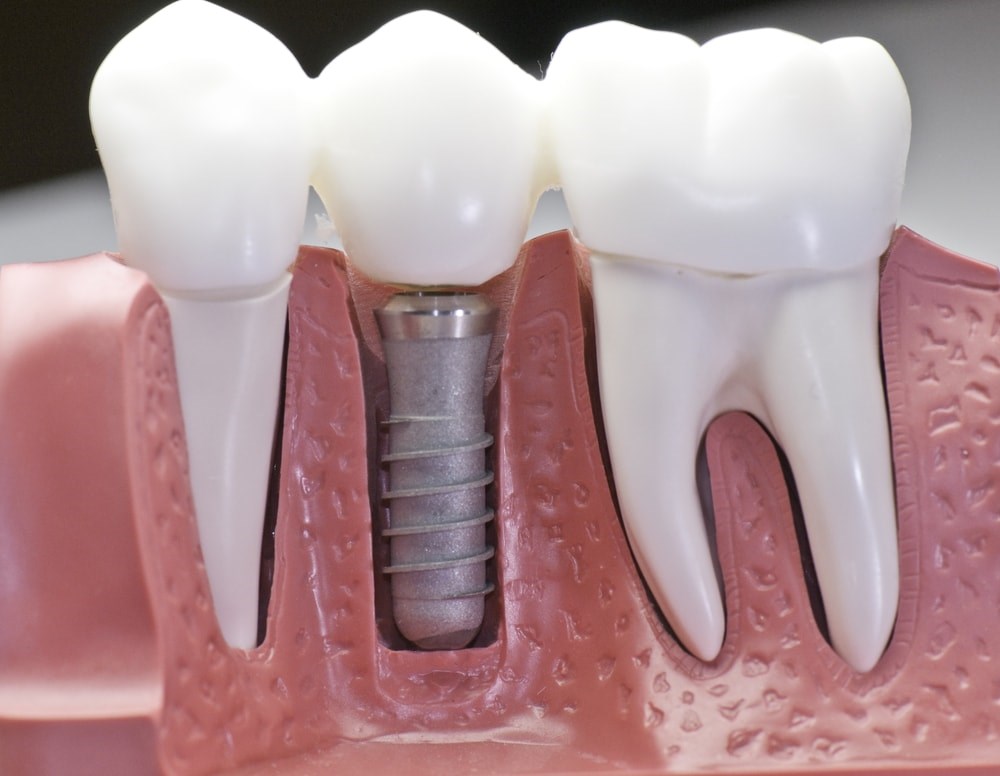 DENTAL iMPLANTS