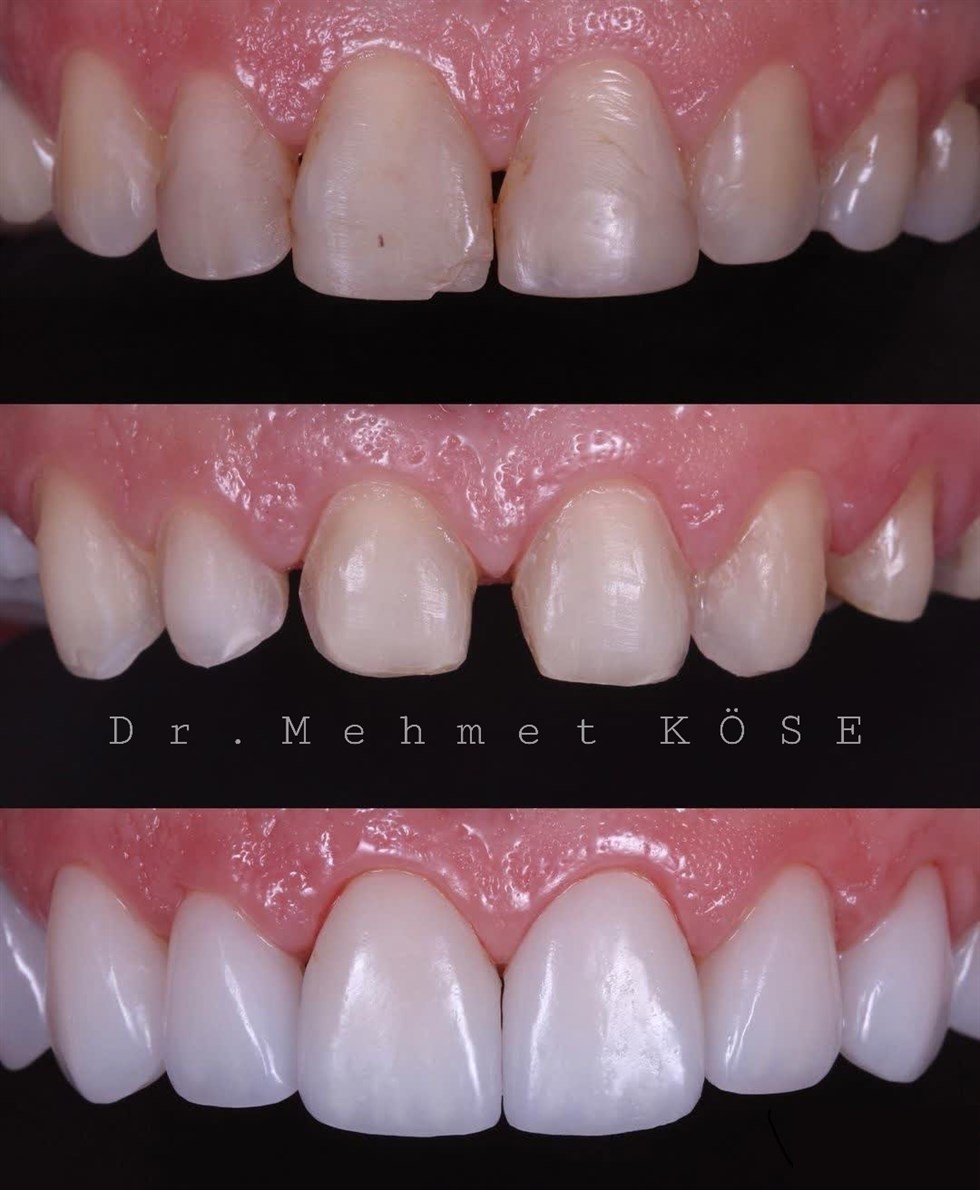 EMAX VENEERS (LAMINATES)