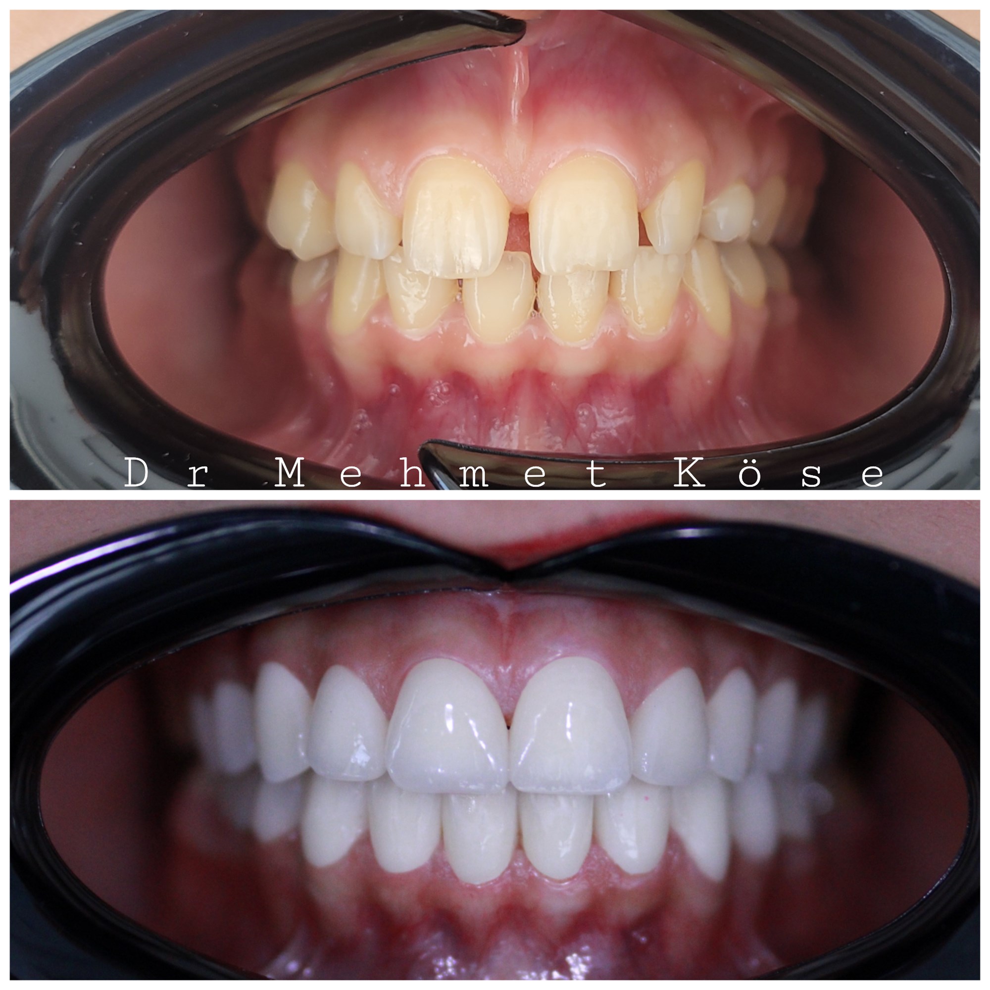 HOLLYWOOD SMİLE with ZIRCONIUM