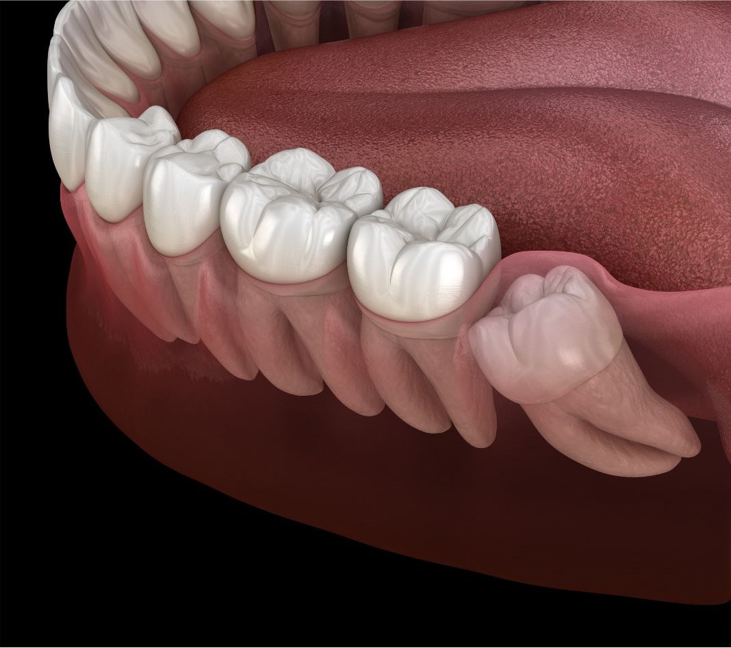 Wisdom tooth exraction